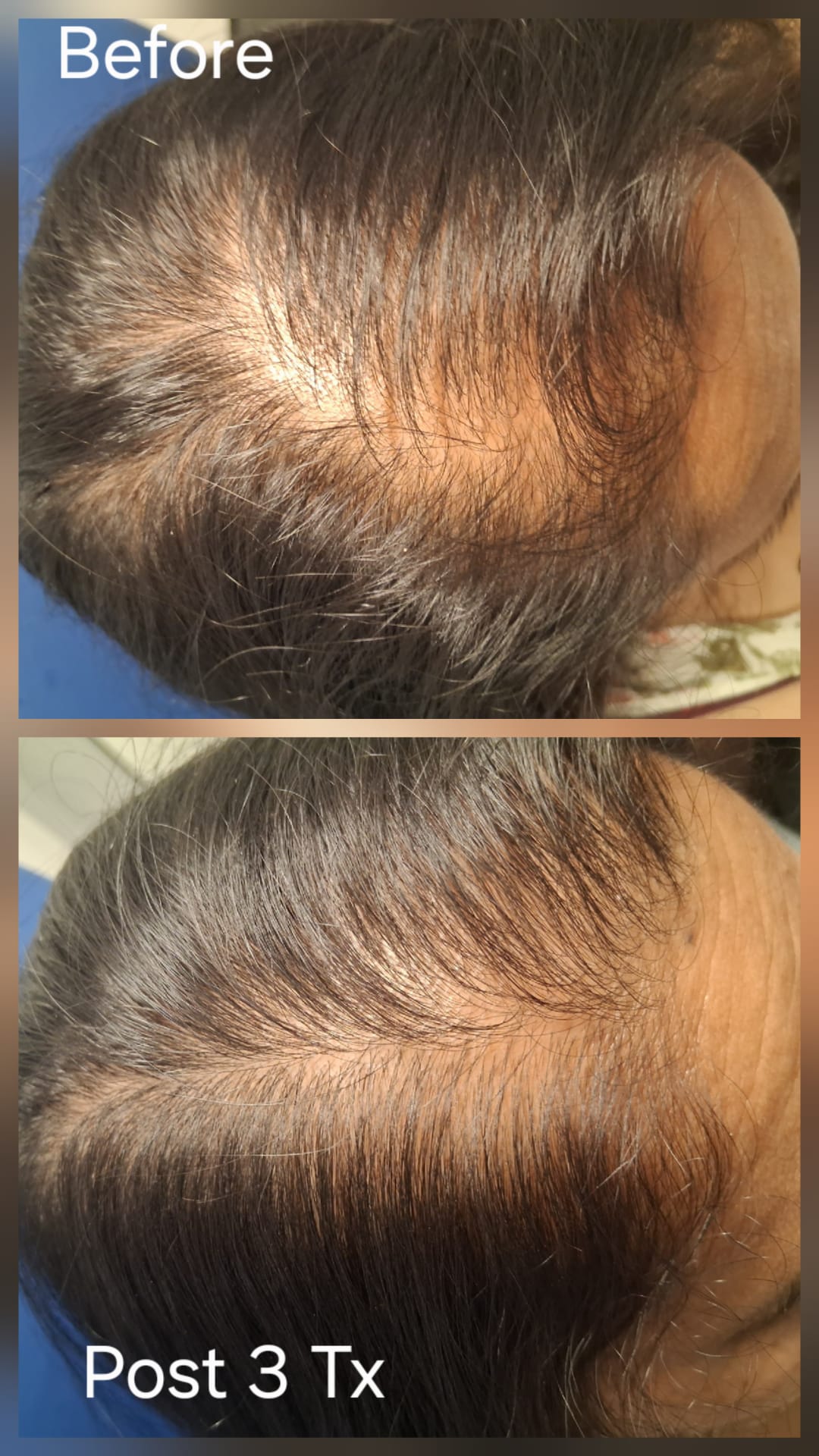 Hair restoration result